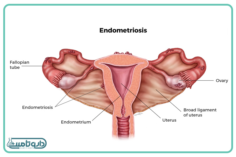 آندومتریوز