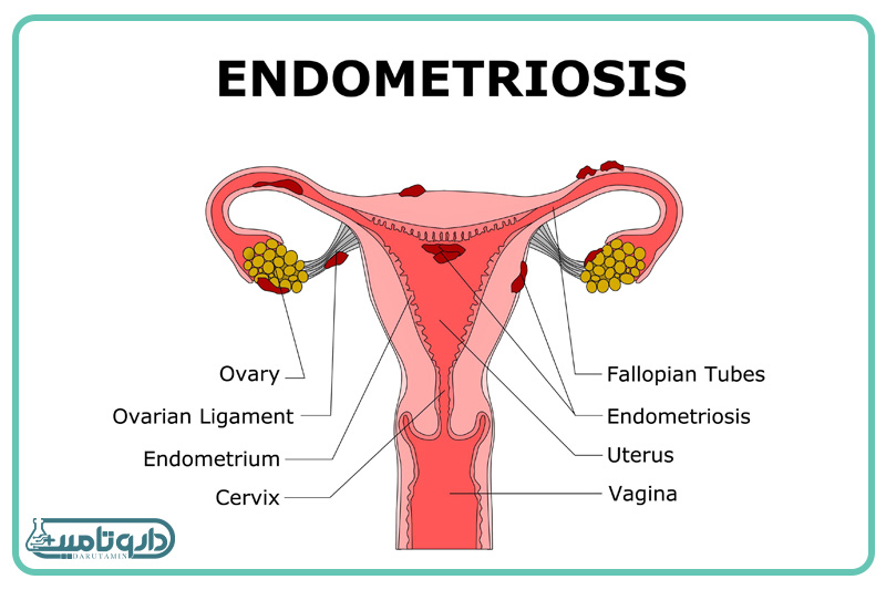 مراحل آندومتریوز