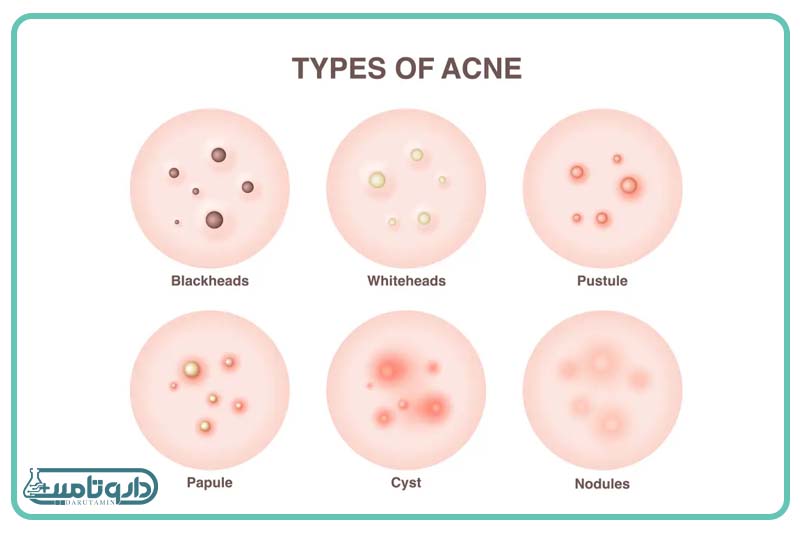 انواع جوش و آکنه