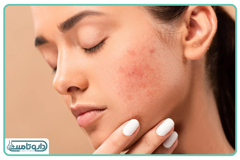 برایت مکس اسپات ژل آکنه برایت