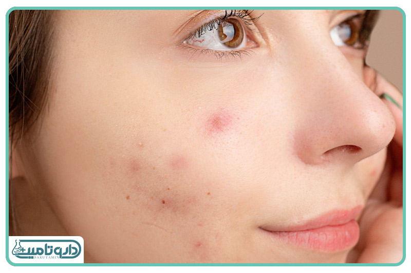 برایت مکس اسپات ژل آکنه برایت