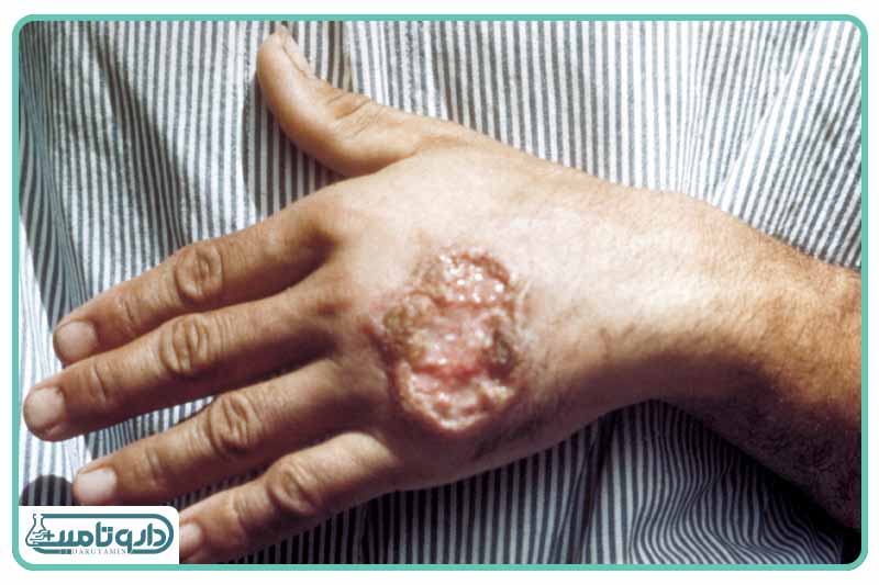 بیماری های (NTDs)