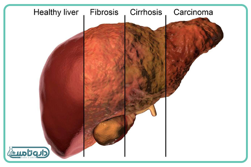 فیبروز کبدی