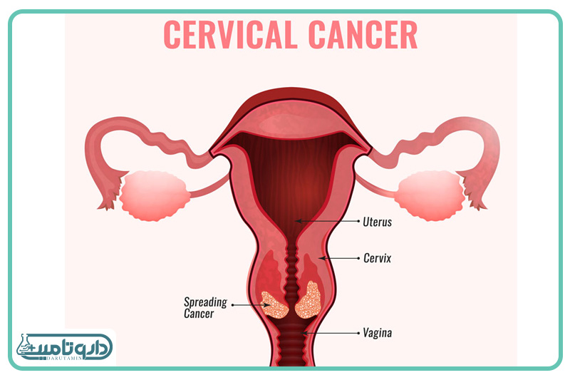 سرطان دهانه رحم