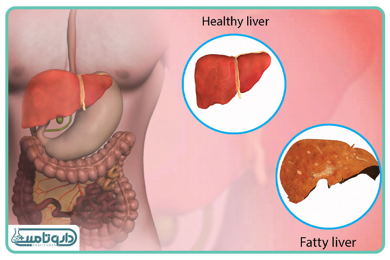 کبد چرب الکلی